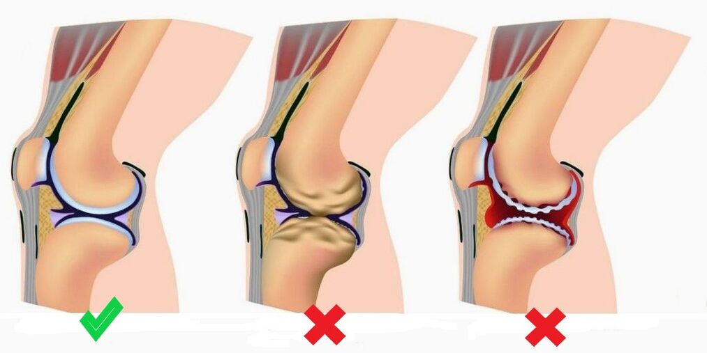 Depanten prevents the development of arthritis and joint disease