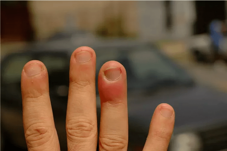 Periungual panaritium, causing finger joint pain