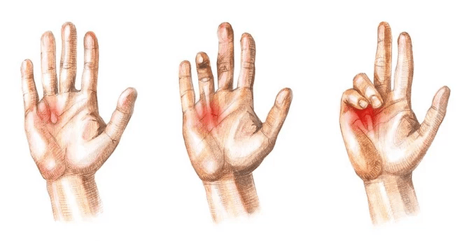 Stages of palmar aponeurosis contracture - inability to straighten fingers