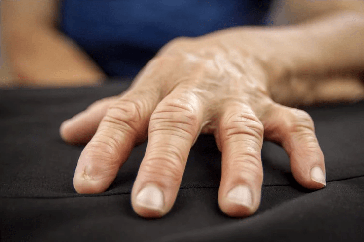 When you have gout, your finger joints feel hot, swollen, and painful to the touch. 