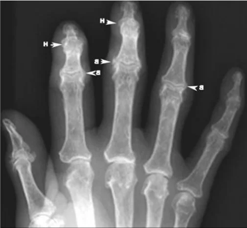 X-ray showing osteophytes in finger joint osteoarthritis