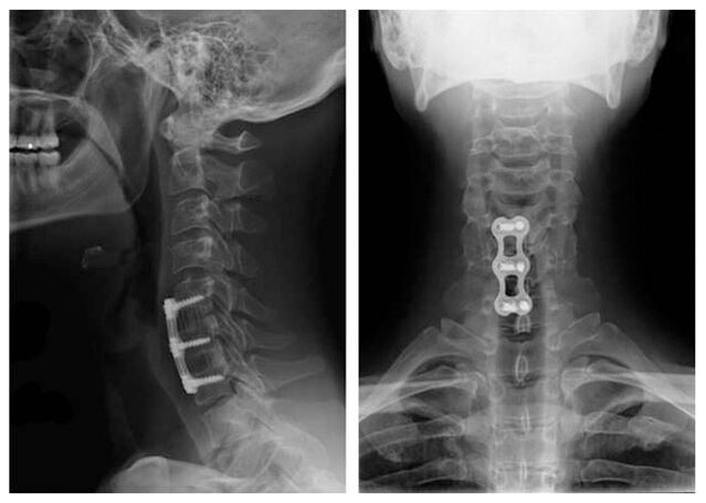 Pictures after vertebrae treatment