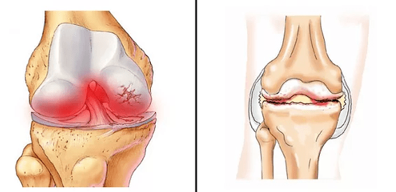 Arthritis comparison