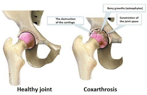 Healthy joints affected by Coksartrosis joints