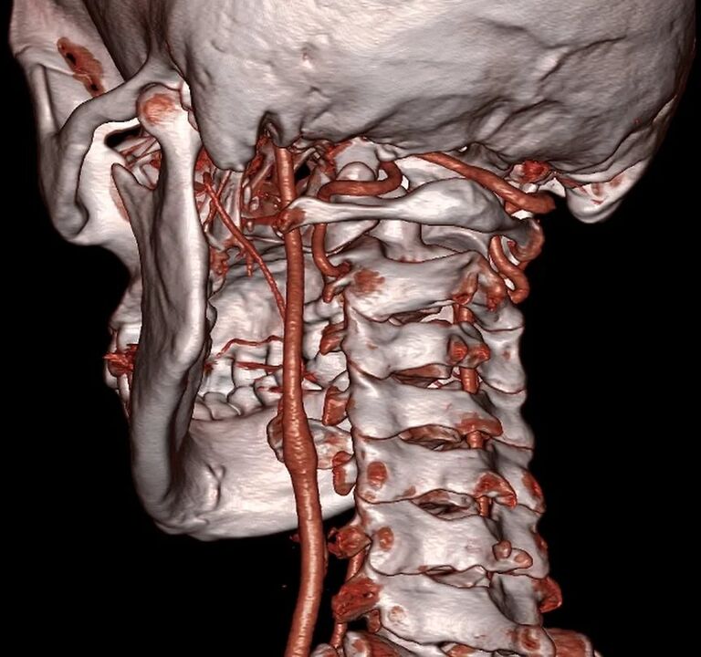cervical osteochondrosis pinched artery