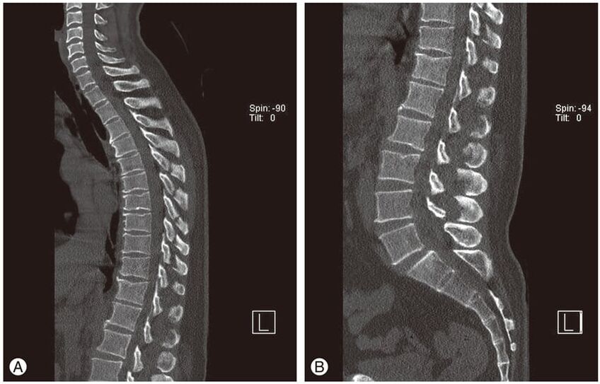 Thoracic osteochondrosis MRI image intervertebral disc deformation