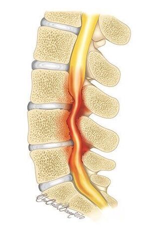 Thoracic osteochondrosis compresses the spinal canal