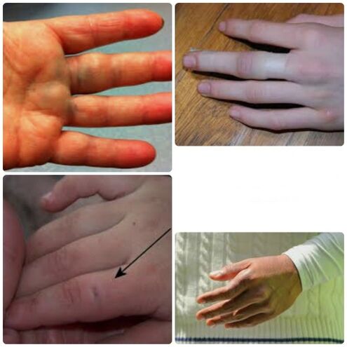 Bruised and broken fingers are characterized by joint pain and swelling