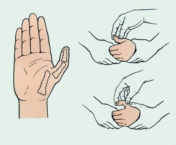 Repositioning a dislocated finger, which is necessary to eliminate joint pain