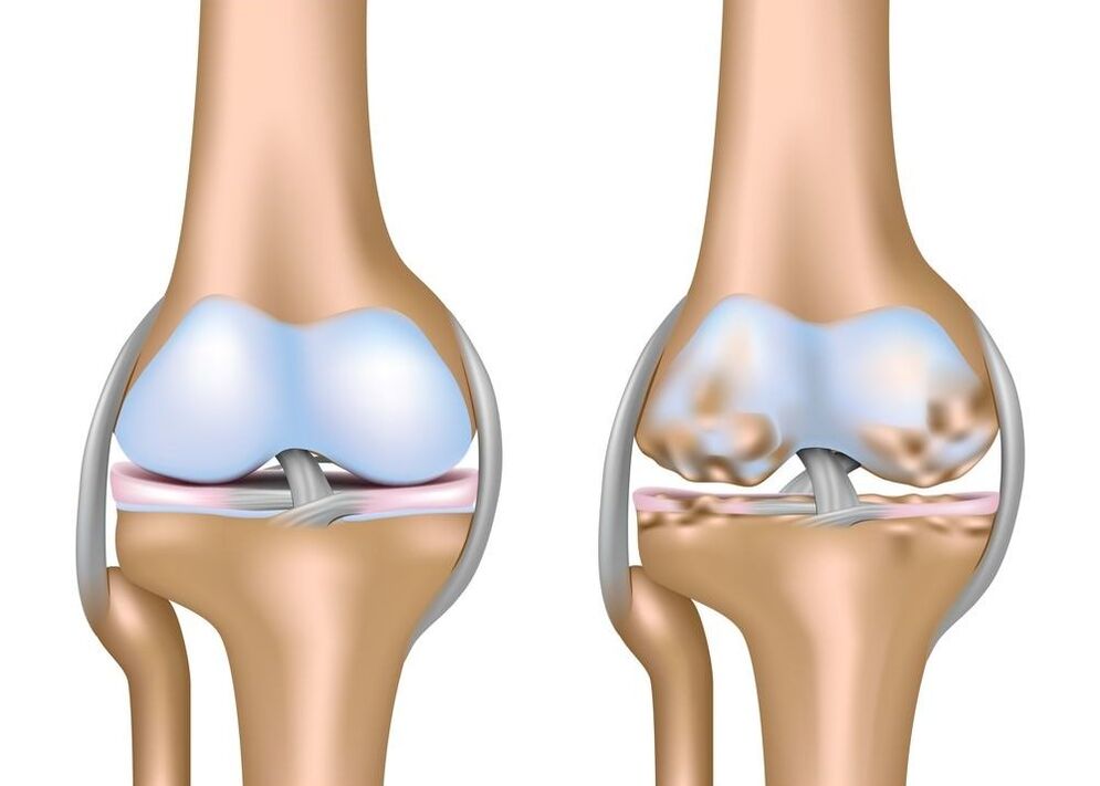 Worsening of joint arthritis