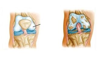 Pathological changes of knee joint