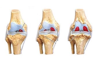 Stages of development of knee arthritis