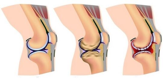 Healthy joints and pain from knee joint destruction