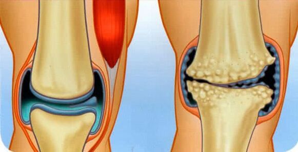 Healthy joints and joint arthropathy