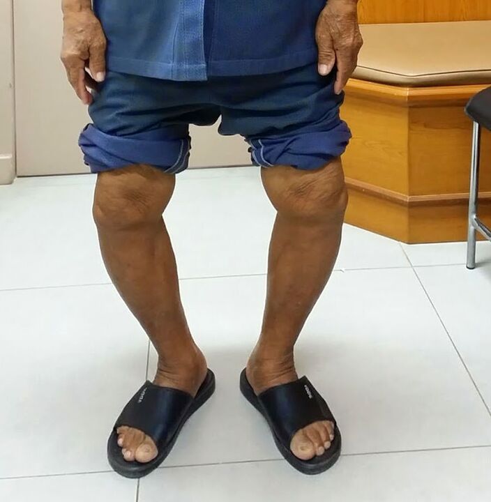 Knee deformity with arthropathy