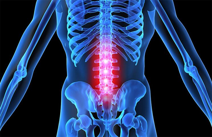 lumbar osteochondrosis