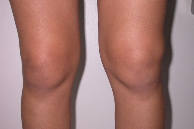 Knee swelling with arthritis and joint disease