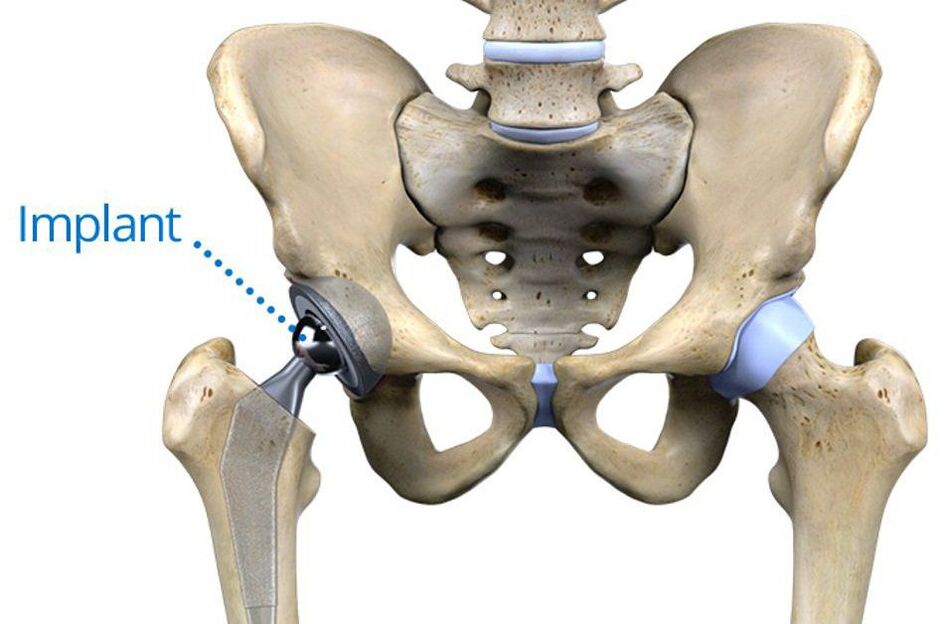 Arthropathy Total Hip Replacement