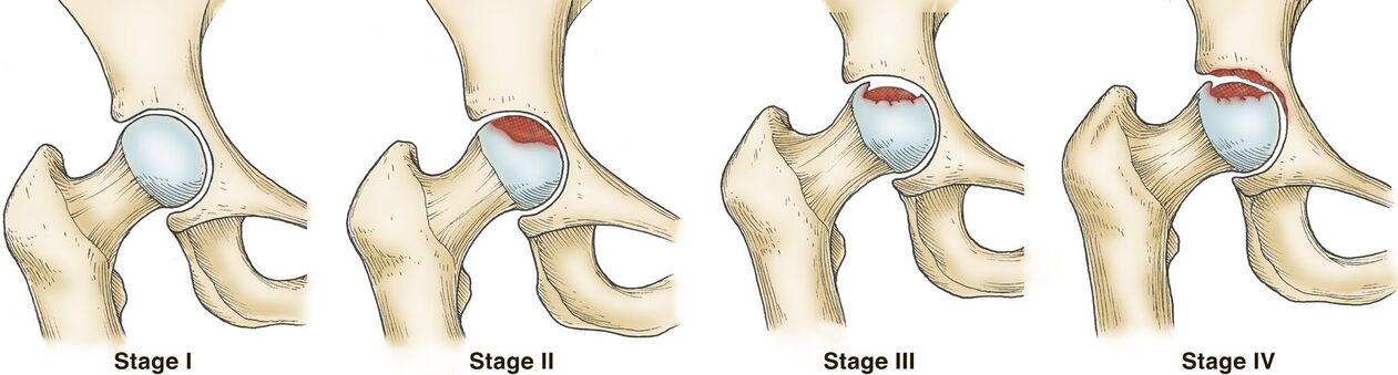 Degree of arthropathy of the hip