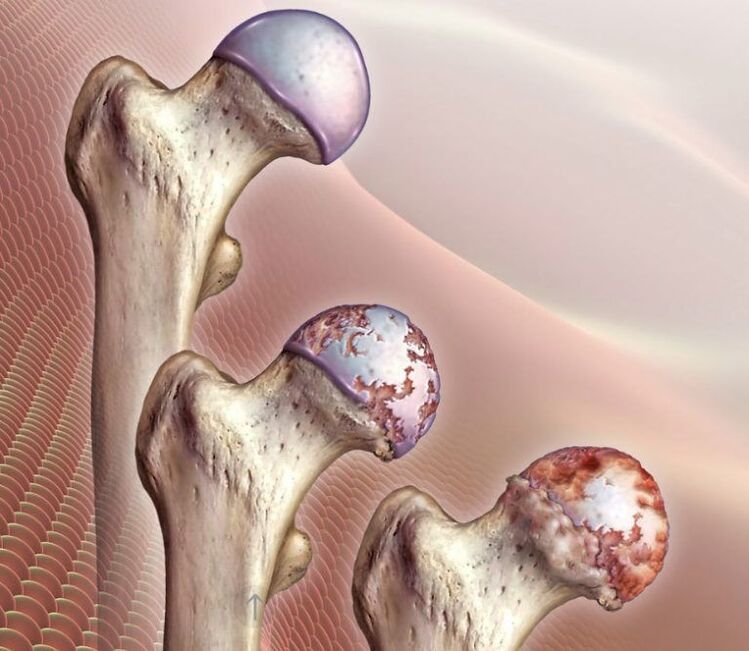 Different degrees of hip arthropathy