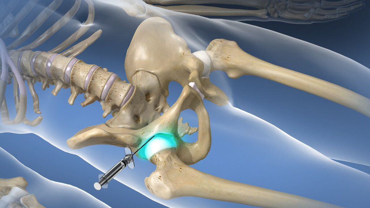 Intra-articular block for severe pain associated with hip arthropathy