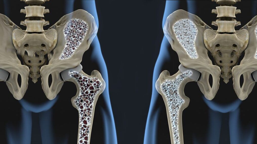 Osteoporosis is a cause of hip fractures and hip joint disease