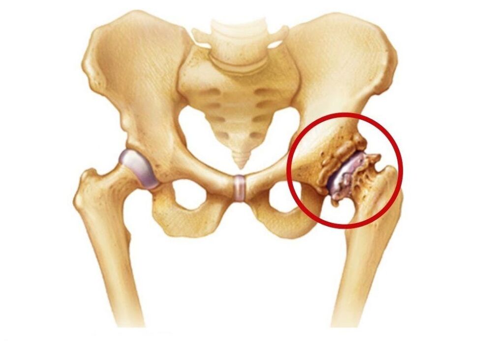 hip joint affected by arthropathy