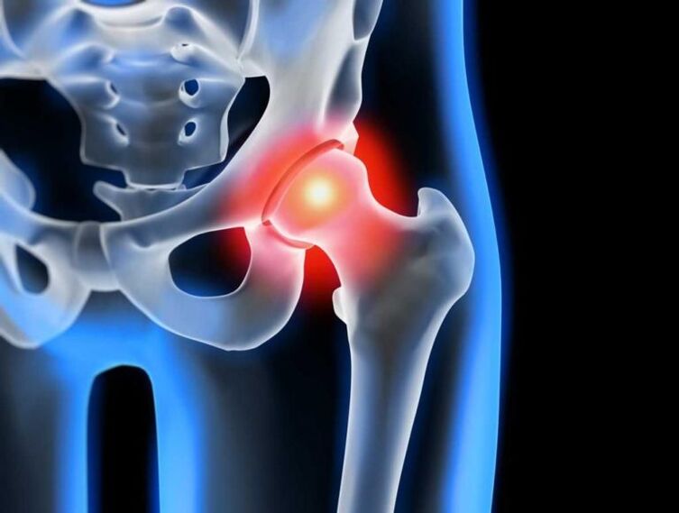 hip joint disease