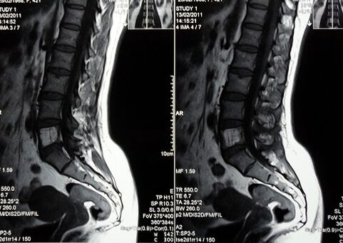 MRI of the lumbosacral spine in the diagnosis of low back pain