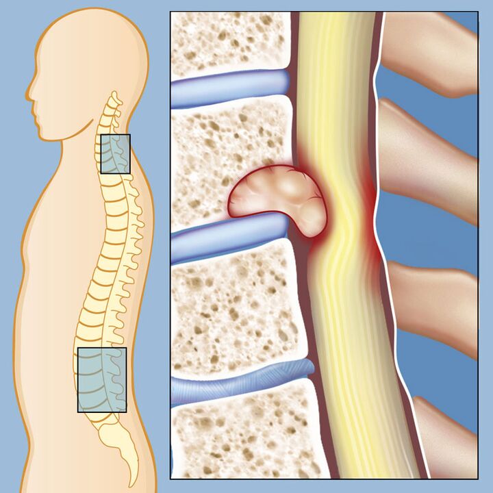 Malignant tumors are the cause of severe low back pain